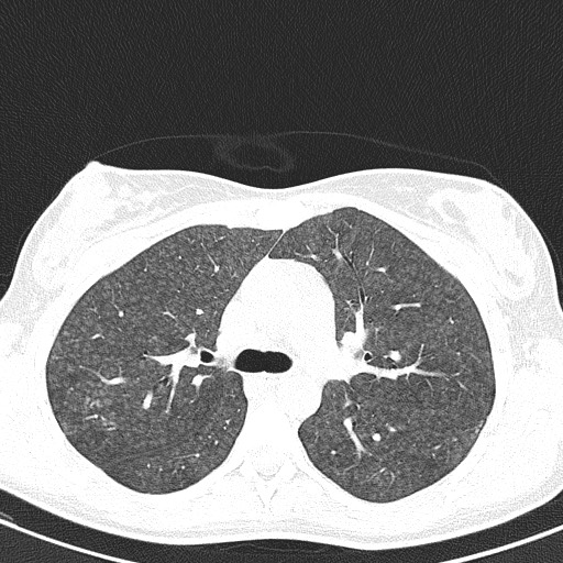 File:Acute hypersensitivity pneumonitis (Radiopaedia 85293-100870 Axial lung window 41).jpg