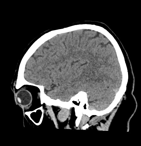 Acute internal carotid artery dissection (Radiopaedia 53541-59558 Sagittal non-contrast 17).jpg