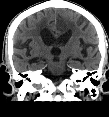 File:Acute left anterior cerebral artery territory infarction (Radiopaedia 51785-57578 Coronal non-contrast 32).jpg