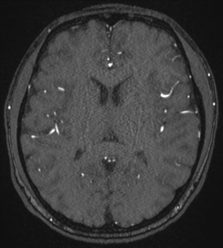 Acute left middle cerebral artery territory infarct with clot retrieval (Radiopaedia 47732-52433 Axial MRA 36).png