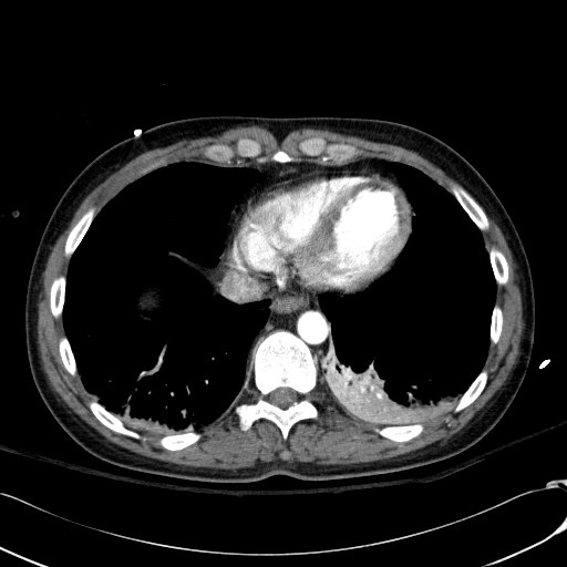 File:Acute myocardial infarction in CT (Radiopaedia 39947-42415 Axial C+ arterial phase 107).jpg