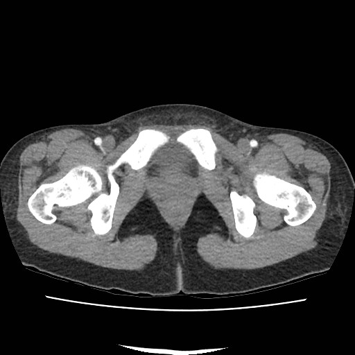 Acute myocarditis (Radiopaedia 55988-62613 Axial C+ portal venous phase 81).jpg
