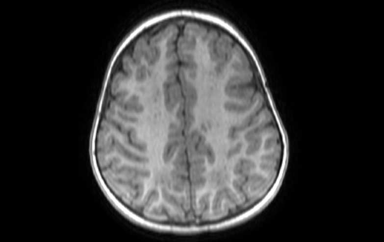 File:Acute necrotizing encephalitis of childhood (Radiopaedia 67356-76737 Axial T1 25).jpg