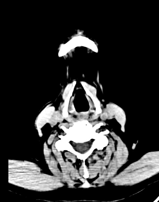 Acute on chronic subdural hematoma (Radiopaedia 74814-85823 Axial non-contrast 1).jpg