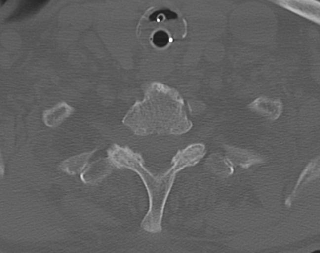 Acute on chronic subdural hematoma and thoracic vertebral injury in a multitrauma patient (Radiopaedia 31698-32619 Axial bone window 53).jpg