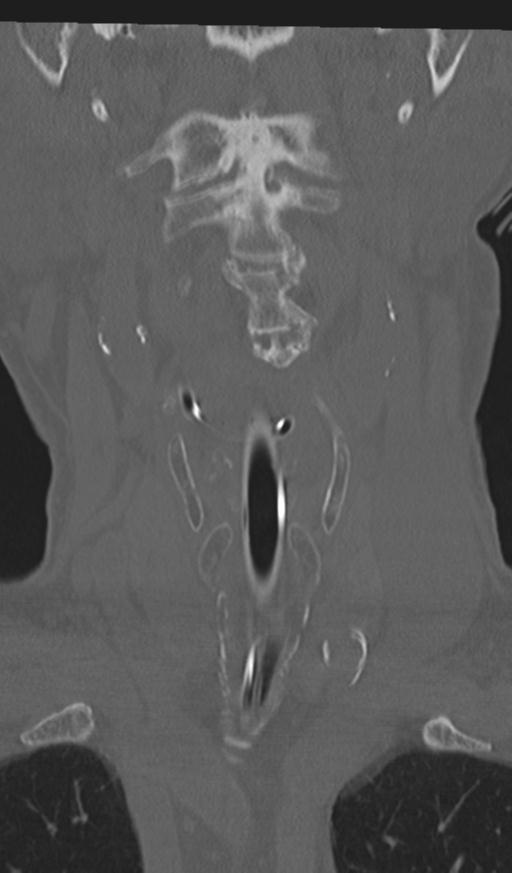 Acute on chronic subdural hematoma and thoracic vertebral injury in a multitrauma patient (Radiopaedia 31698-32619 Coronal bone window 10).jpg