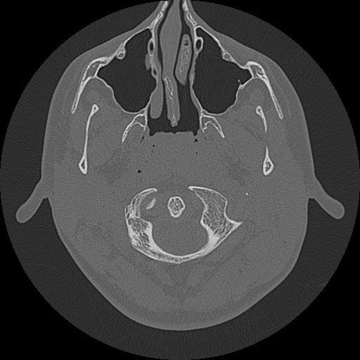 Acute otomastoiditis and Bezold abscess (Radiopaedia 88184-104786 Axial bone window 3).jpg