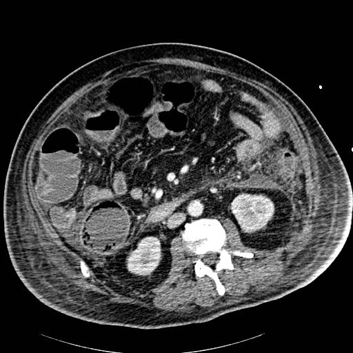 Acute pancreatic necrosis (Radiopaedia 13560-18502 Axial C+ portal venous phase 52).jpg