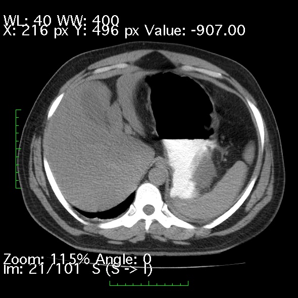 File:Acute pancreatitis (Radiopaedia 34043-35276 Axial non-contrast 21).jpg