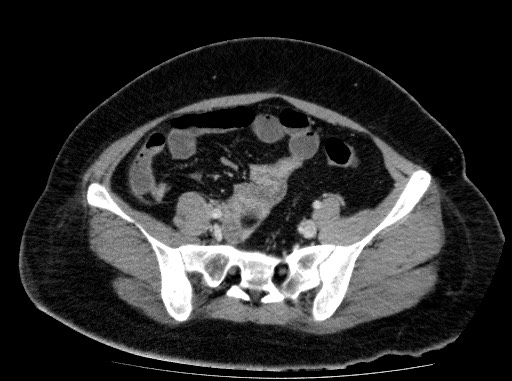 Acute pancreatitis (Radiopaedia 69236-79012 Axial C+ portal venous phase 70).jpg