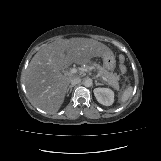 Acute pancreatitis (Radiopaedia 80007-93285 Axial C+ portal venous phase 41).jpg