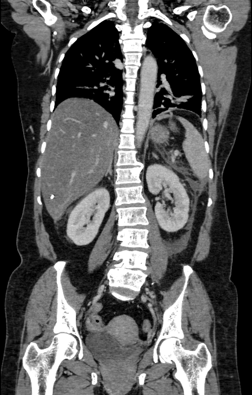 Acute pancreatitis (Radiopaedia 80007-93285 Coronal C+ portal venous phase 97).jpg