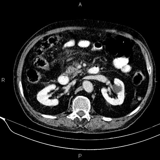 File:Acute pancreatitis (Radiopaedia 85146-100701 Axial C+ portal venous phase 29).jpg