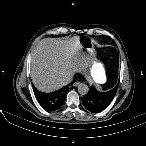 File:Acute pancreatitis (Radiopaedia 85146-100701 Axial non-contrast 20).jpg