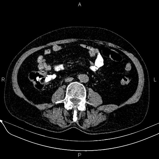 Acute pancreatitis (Radiopaedia 85146-100701 Axial non-contrast 74).jpg