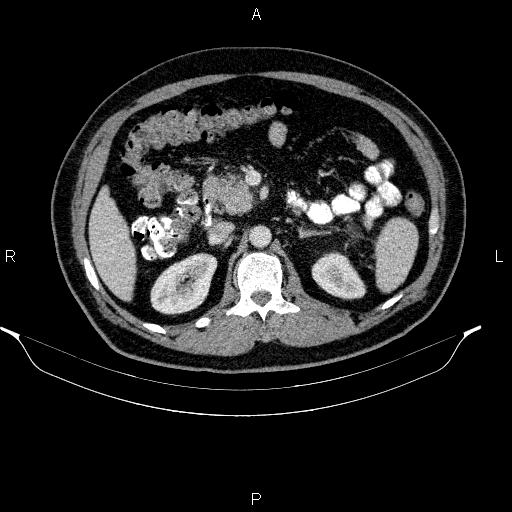 Acute pancreatitis (Radiopaedia 85390-101010 Axial C+ portal venous phase 40).jpg