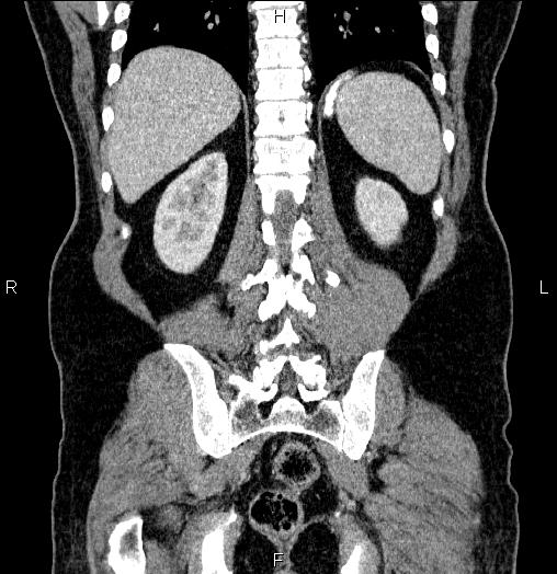 File:Acute pancreatitis (Radiopaedia 85390-101010 Coronal C+ portal venous phase 57).jpg