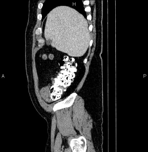 Acute pancreatitis (Radiopaedia 85390-101010 Sagittal C+ portal venous phase 10).jpg