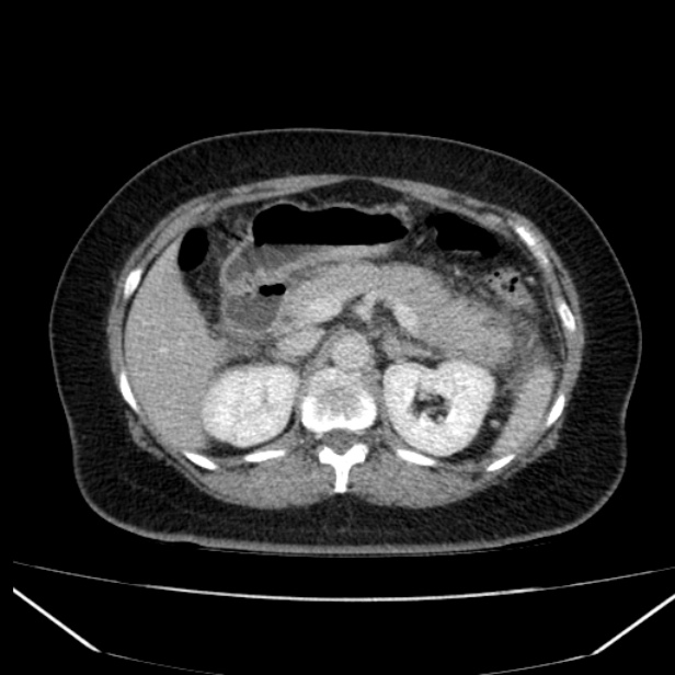 Acute pancreatitis - Balthazar C (Radiopaedia 26569-26714 Axial C+ portal venous phase 37).jpg