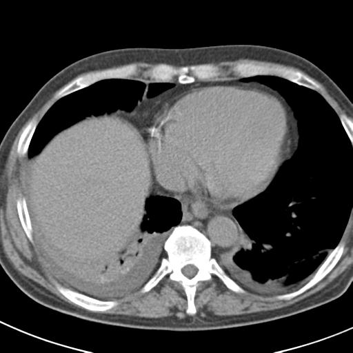 File:Acute pancreatitis and walled-off necrosis (Radiopaedia 29888-30403 Axial non-contrast 3).jpg