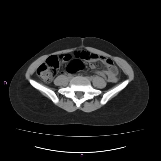 Acute pancreatitis secondary to stone at minor papilla and pancreatic divisum (Radiopaedia 76570-88333 Axial non-contrast 49).jpg