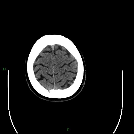 Acute posterior cerebral artery territory infarct (Radiopaedia 79329-92393 Axial non-contrast 99).jpg