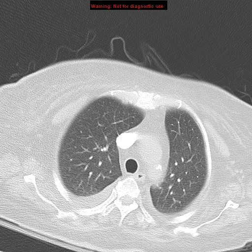 File:Acute pulmonary embolism (Radiopaedia 13286-13289 B 12).jpg