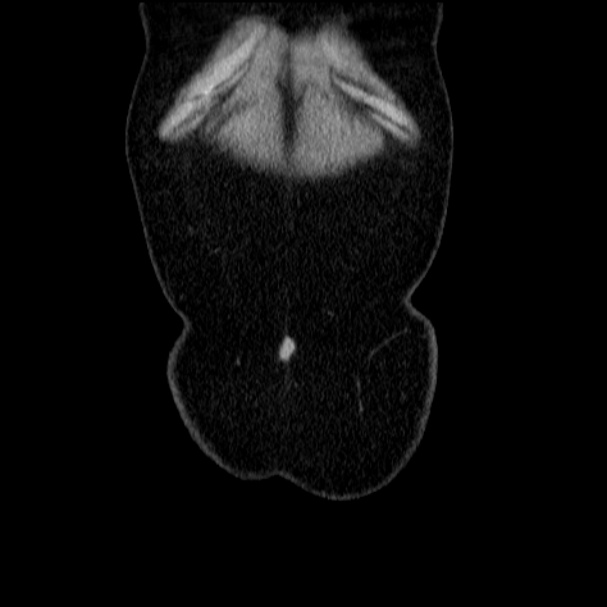 Acute pyelonephritis (Radiopaedia 33397-34434 Coronal renal parenchymal phase 12).jpg