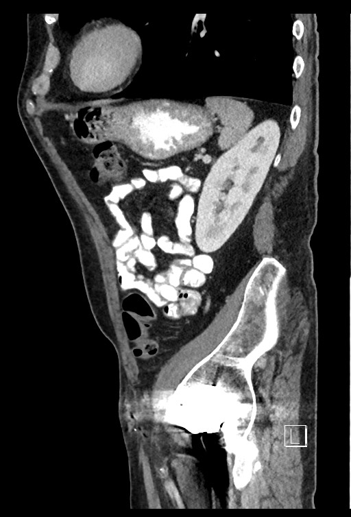 Acute renal infarction - rim capsular enhancement (Radiopaedia 59833-67270 Sagittal C+ portal venous phase 27).jpg