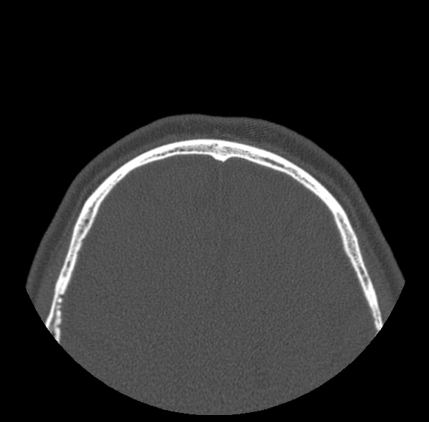 Acute sinusitis (Radiopaedia 23161-23215 Axial bone window 83).jpg