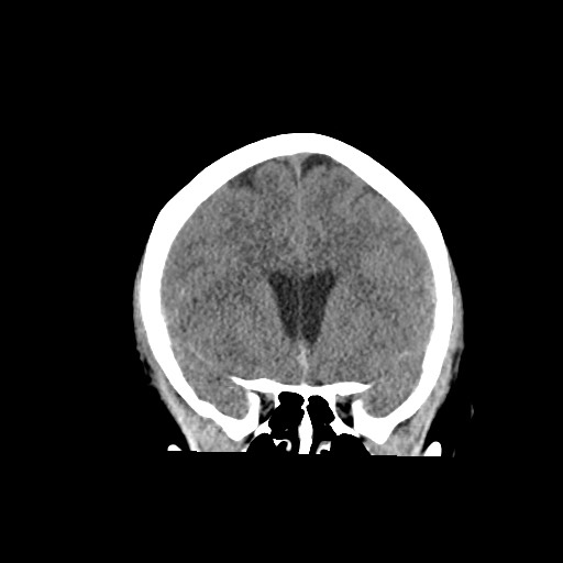 Acute subarachnoid hemorrhage and accessory anterior cerebral artery (Radiopaedia 69231-79008 Coronal non-contrast 28).jpg