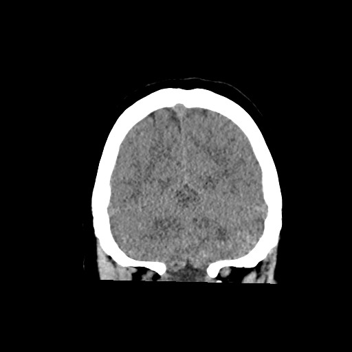 Acute subarachnoid hemorrhage and accessory anterior cerebral artery (Radiopaedia 69231-79008 Coronal non-contrast 57).jpg