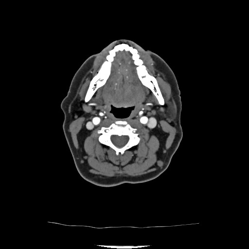 File:Acute subarachnoid hemorrhage and accessory anterior cerebral artery (Radiopaedia 69231-79009 Axial C+ arterial phase 58).jpg