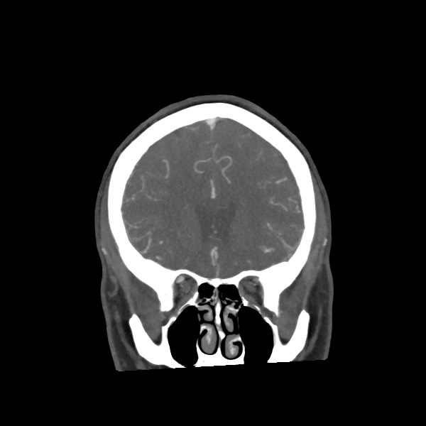 Acute subarachnoid hemorrhage and accessory anterior cerebral artery (Radiopaedia 69231-79009 Coronal C+ arterial phase 27).jpg