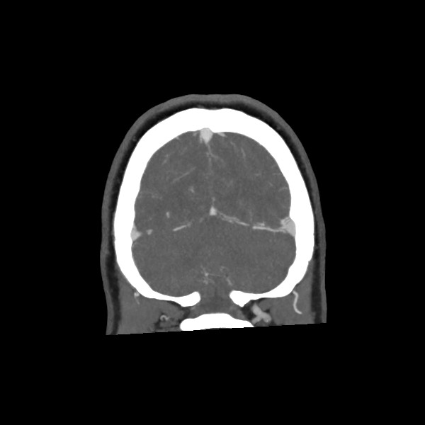 File:Acute subarachnoid hemorrhage and accessory anterior cerebral artery (Radiopaedia 69231-79009 Coronal C+ arterial phase 69).jpg