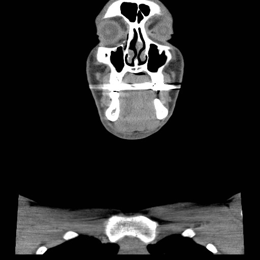 File:Acute submandibular sialadenitis secondary to ductal stone (Radiopaedia 27999-28267 Coronal C+ delayed 15).jpg