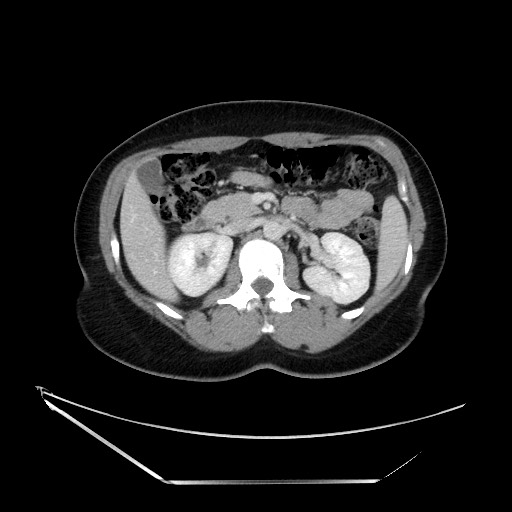 Acute uncomplicated appendicitis (Radiopaedia 73704-84499 Axial C+ portal venous phase 56).jpg