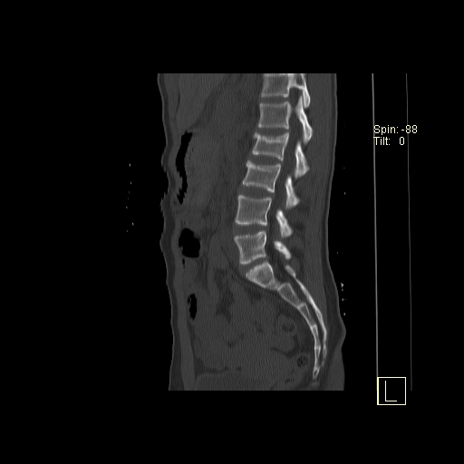 File:Acute vertebral compression fracture (Radiopaedia 63832-72559 Sagittal bone window 7).jpg