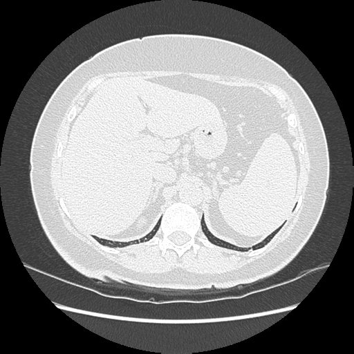 Adenocarcinoma in situ of lung (Radiopaedia 38685-40829 B 213).png