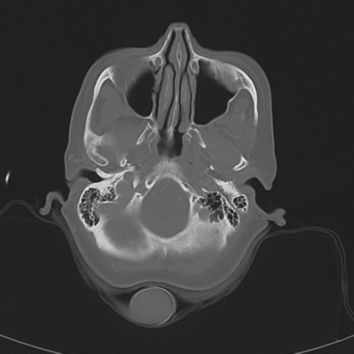 Adenoid cystic tumor of palate (Radiopaedia 46980-51518 Axial bone window 19).png