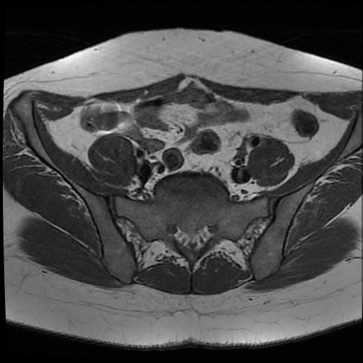 File:Adenomyosis-scar endometriosis (Radiopaedia 65863-75022 Axial T1 6).jpg