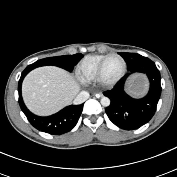 Adhesional small bowel obstruction (Radiopaedia 52107-57980 Axial C+ portal venous phase 7).jpg