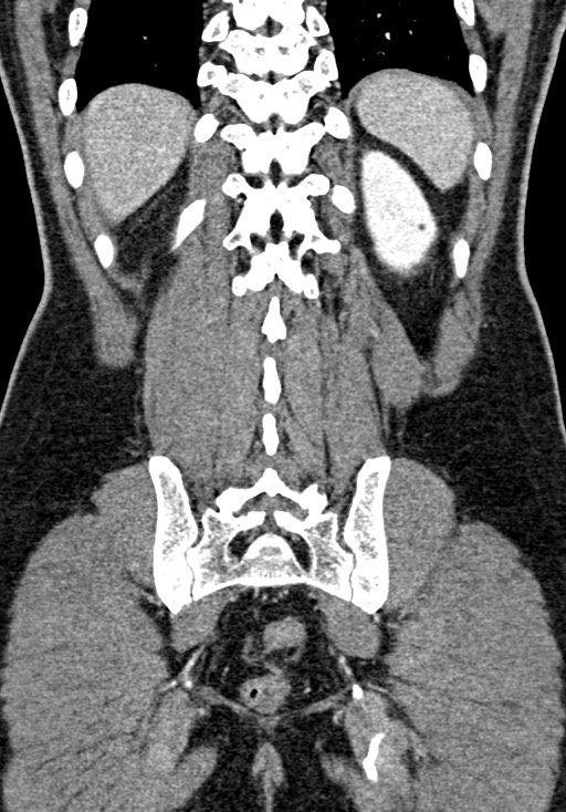 Adhesional small bowel obstruction (Radiopaedia 58900-66131 Coronal C+ portal venous phase 200).jpg