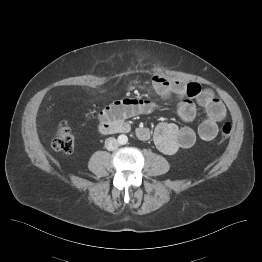 Adhesions within abdominal wall hernia (Radiopaedia 58283-65394 Axial C+ portal venous phase 48).png