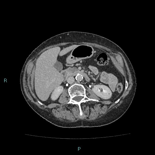 File:Adrenal collision tumor (ACT) (Radiopaedia 48462-53379 Axial C+ delayed 30).jpg