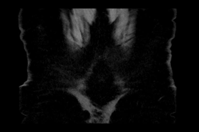 Adrenal cortical carcinoma (Radiopaedia 64017-72769 Coronal non-contrast 57).jpg