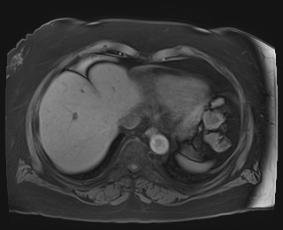 Adrenal cortical carcinoma (Radiopaedia 64017-72770 Axial T1 fat sat 3).jpg