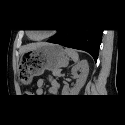 Adrenal gland trauma (Radiopaedia 81351-95079 Sagittal non-contrast 70).jpg