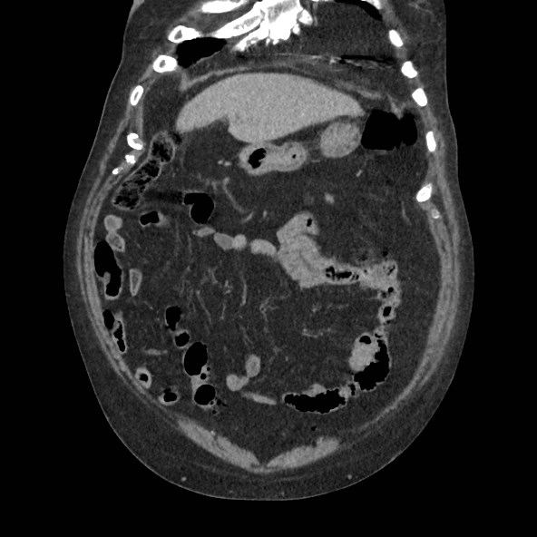 Adrenal lymphoma (Radiopaedia 84145-99415 Coronal C+ portal venous phase 17).jpg