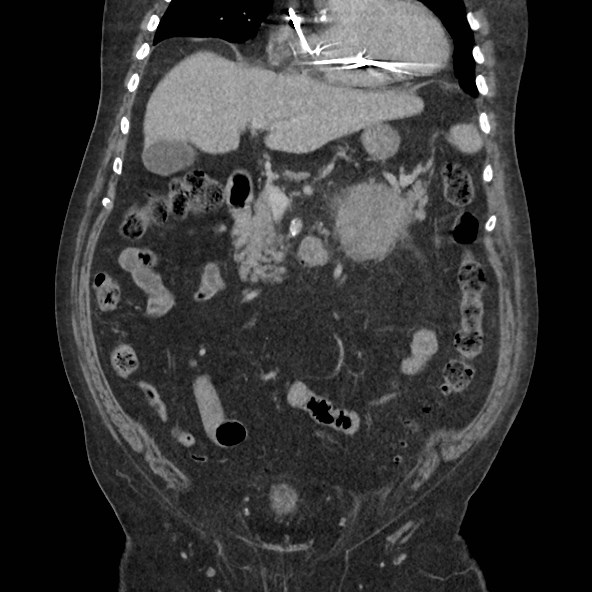 Adrenal lymphoma (Radiopaedia 84145-99415 Coronal C+ portal venous phase 31).jpg